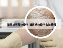 银屑病可能吃橙子 银屑病吃橙子会加重吗