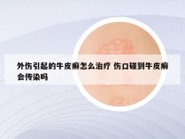 外伤引起的牛皮癣怎么治疗 伤口碰到牛皮癣会传染吗