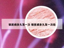 银屑病多久发一次 银屑病多久发一次烧