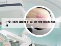 广安门医院白癜风 广安门医院看皮肤科怎么样
