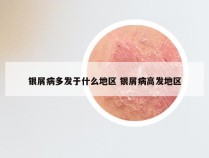 银屑病多发于什么地区 银屑病高发地区