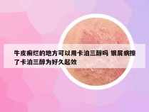 牛皮癣烂的地方可以用卡泊三醇吗 银屑病擦了卡泊三醇为好久起效