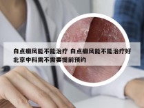 白点癫风能不能治疗 白点癫风能不能治疗好北京中科需不需要提前预约