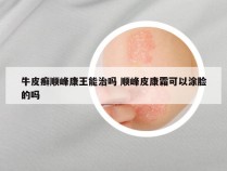 牛皮癣顺峰康王能治吗 顺峰皮康霜可以涂脸的吗