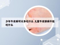 少年牛皮癣可以多吃什么 儿童牛皮肤癣不能吃什么