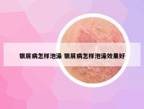 银屑病怎样泡澡 银屑病怎样泡澡效果好
