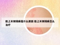 脸上长铜钱癣是什么原因 脸上长铜钱癣怎么治疗