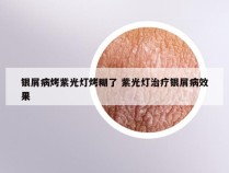 银屑病烤紫光灯烤糊了 紫光灯治疗银屑病效果