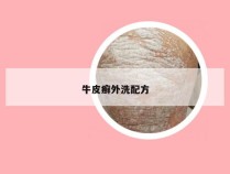 牛皮癣外洗配方