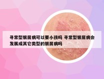寻常型银屑病可以要小孩吗 寻常型银屑病会发展成其它类型的银屑病吗
