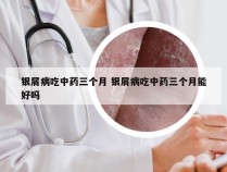银屑病吃中药三个月 银屑病吃中药三个月能好吗