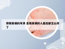 得银屑病的导演 患银屑病的人最后都怎么样了