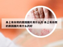 身上有白斑的原因图片用什么药 身上有白斑的原因图片用什么药好