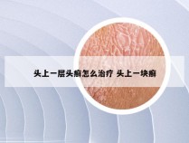 头上一层头癣怎么治疗 头上一块癣