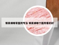 银屑病哪家医院专治 银屑病哪个医院看的好