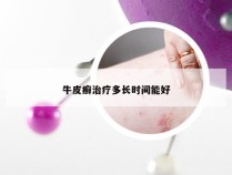 牛皮癣治疗多长时间能好