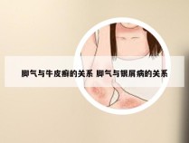 脚气与牛皮癣的关系 脚气与银屑病的关系