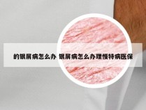 的银屑病怎么办 银屑病怎么办理慢特病医保