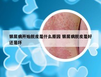 银屑病开始脱皮是什么原因 银屑病脱皮是好还是坏