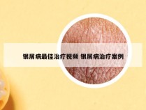 银屑病最佳治疗视频 银屑病治疗案例