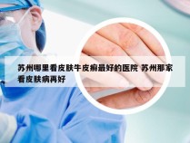 苏州哪里看皮肤牛皮癣最好的医院 苏州那家看皮肤病再好