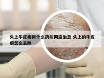 头上牛皮癣用什么药能彻底治愈 头上的牛皮癣怎么去除