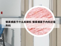银屑病属于什么皮肤科 银屑病属于内科还是外科
