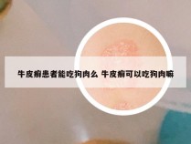 牛皮癣患者能吃狗肉么 牛皮癣可以吃狗肉嘛