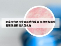 北京协和医院看银屑病和皮炎 北京协和医院看银屑病和皮炎怎么样