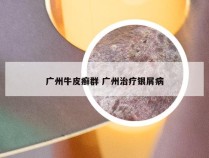 广州牛皮癣群 广州治疗银屑病