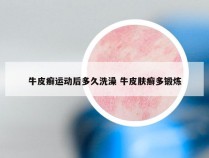 牛皮癣运动后多久洗澡 牛皮肤癣多锻炼