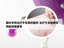国内生物治疗牛皮癣的医院 治疗牛皮肤癣生物制剂哪里有