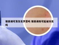 银屑病可发生克罗恩吗 银屑病有可能被攻克吗