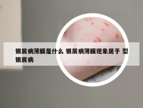 银屑病薄膜是什么 银屑病薄膜现象属于 型银屑病