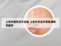 上海中医院治牛皮癣 上海中药治疗银屑病哪家最好