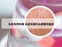 头皮为何长癣 头皮长癣什么原因引起的