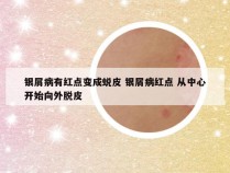 银屑病有红点变成蜕皮 银屑病红点 从中心开始向外脱皮