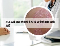 小儿头皮银屑病治疗多少钱 儿童头部银屑病治疗