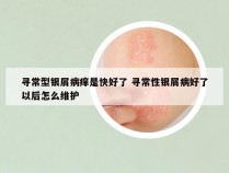寻常型银屑病痒是快好了 寻常性银屑病好了以后怎么维护