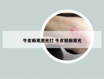 牛皮癣用激光打 牛皮肤癣激光