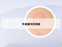 牛皮癣中药泡茶