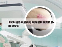 ct可以确诊银屑病吗 初期银屑病做皮肤ct能确定吗
