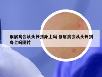 银屑病会从头长到身上吗 银屑病会从头长到身上吗图片