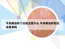牛皮癣治好了以后注意什么 牛皮癣治好后还会复发吗