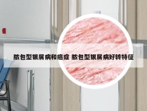 脓包型银屑病和癌症 脓包型银屑病好转特征