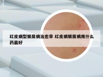 红皮病型银屑病治愈率 红皮病银屑病用什么药最好