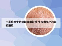 牛皮癣喝中药能彻底治好吗 牛皮癣喝中药好的迹象