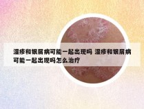 湿疹和银屑病可能一起出现吗 湿疹和银屑病可能一起出现吗怎么治疗
