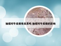 抽烟对牛皮癣有关系吗 抽烟对牛皮癣的影响