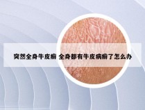 突然全身牛皮癣 全身都有牛皮病癣了怎么办